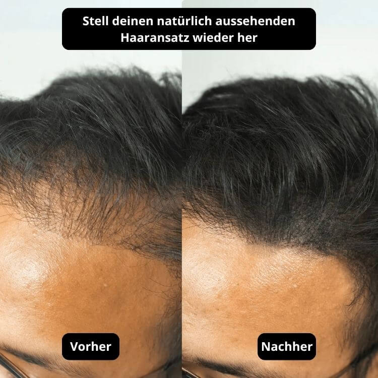 ODALIT® Sofortige Abdeckung für kahle und dünner werdende Stellen