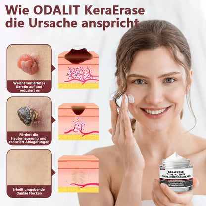 ODALIT®KeraErase Dual-Action Erneuerungscreme
