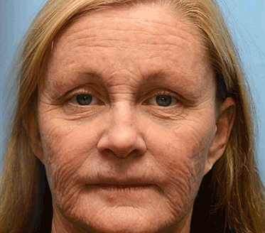 👨‍⚕️ Hergestellt in Deutschland - ✨ODALIT® Botox Bienenvenom Faltenentfernungscreme